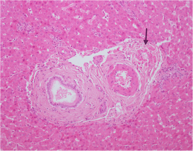 Histopathology of livers in patients with congenital portosystemic
