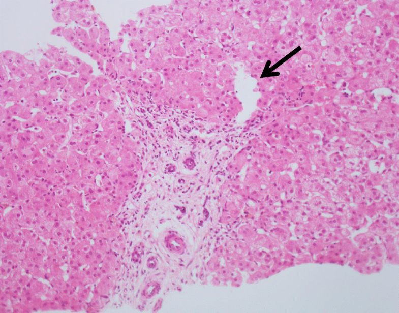 Histopathology of livers in patients with congenital portosystemic