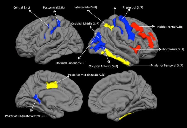 Abnormalities in structural covariance of cortical gyrification in ...