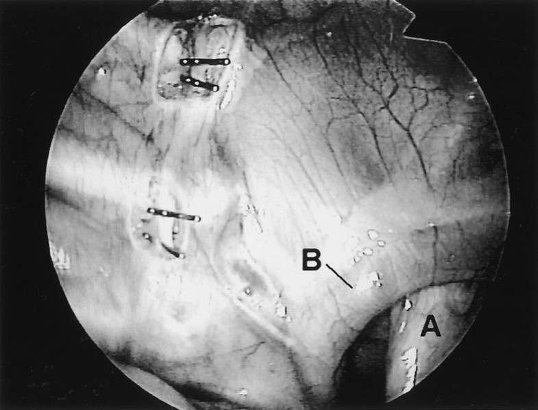 Azygos lobe in endoscopic thoracic sympathectomy for hyperhidrosis