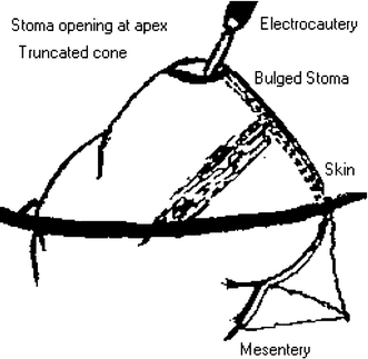 New “sutureless” technique of ileostomy and colostomy | SpringerLink