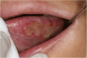 oral mucosa problem induced changes Oral by targeted mucosal anticancer