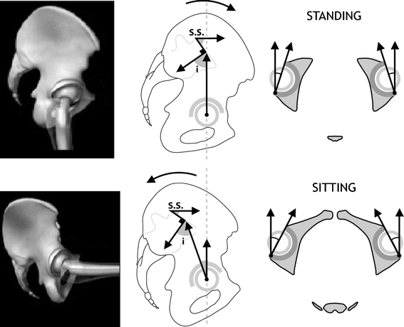 Hip–spine relations and sagittal balance clinical consequences ...