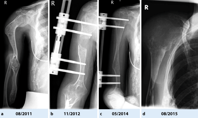 Entartungsrisiko von gutartigen Knochenläsionen | SpringerLink