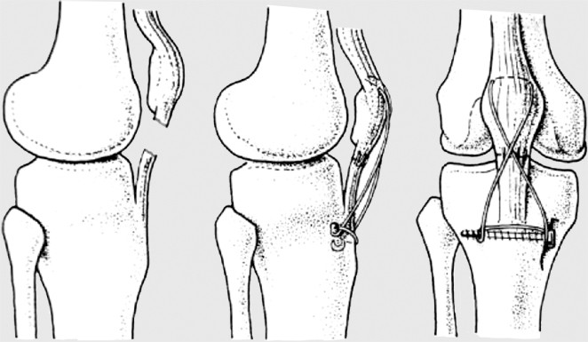 Patellarsehnenruptur SpringerLink