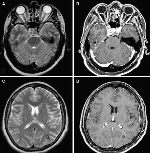 Trigeminal neuralgia and persistent trigeminal artery | SpringerLink