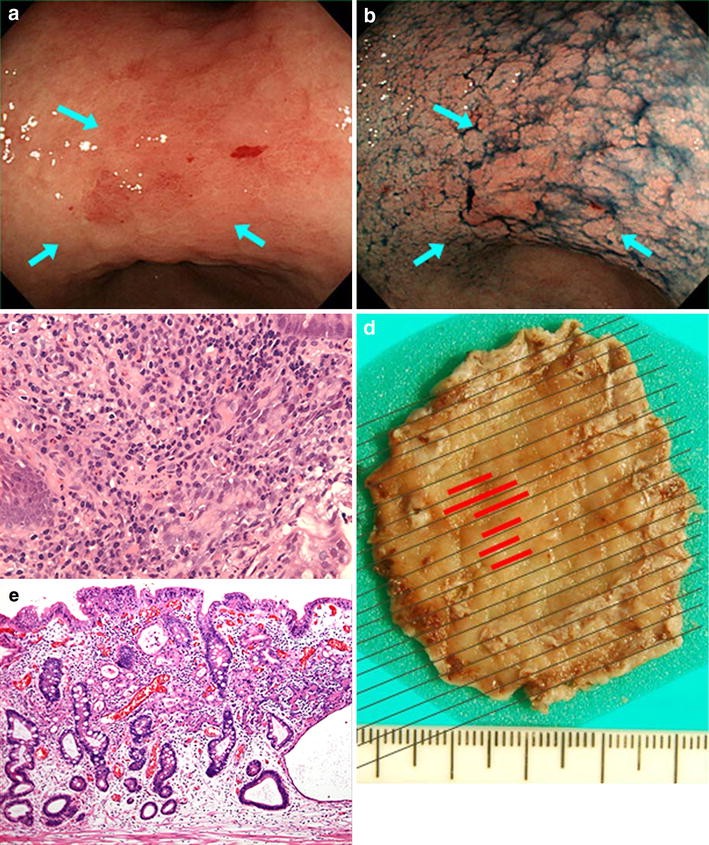 Discrepancies in histologic diagnoses of early gastric cancer between