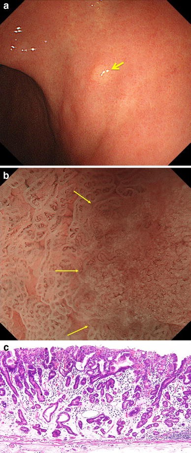 Magnifying Endoscopy With Narrow Band Imaging Is Useful In The Differential Diagnosis Between