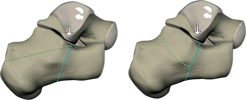 Intra-articular tongue-type fractures of the calcaneus: anatomy, injury ...