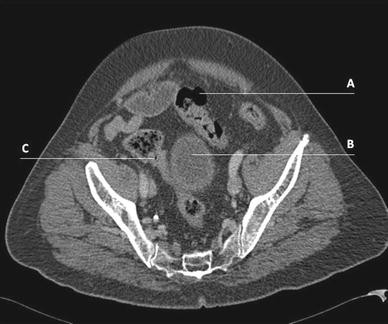 Preoperative staging of perforated diverticulitis by computed ...