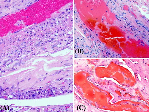 Hydralazine-induced autoimmune disease: comparison to idiopathic lupus ...