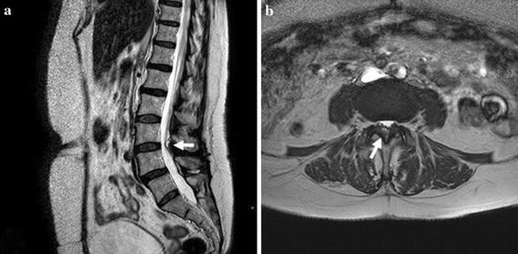 Ligamentum flavum cyst in the lumbar spine: a case report ...