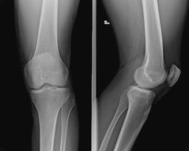 Symptomatic snapping knee from biceps femoris tendon subluxation: an ...