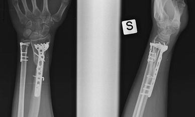 plate distal fracture fixation radius ulnar acumed fractures open involvement volar diaphyseal angle fixed fig1 fig