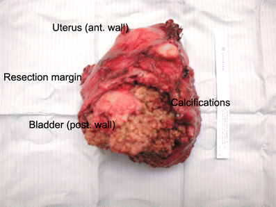 Calcifying uterine leiomyoma invading the urinary bladder ...