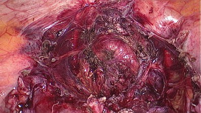 Laparoscopic hysterectomy in frozen pelvis—an alternative ... frozen pelvis diagram 