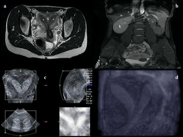 Septate uterus nosographic overview and endoscopic treatment