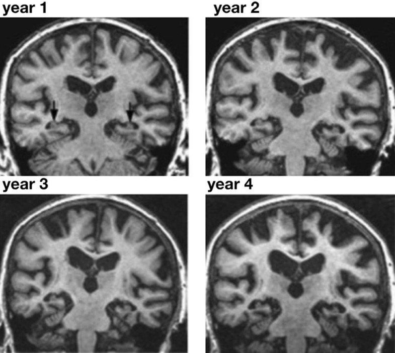 The Shrinking Brain Cerebral Atrophy Following Traumatic Brain Injury