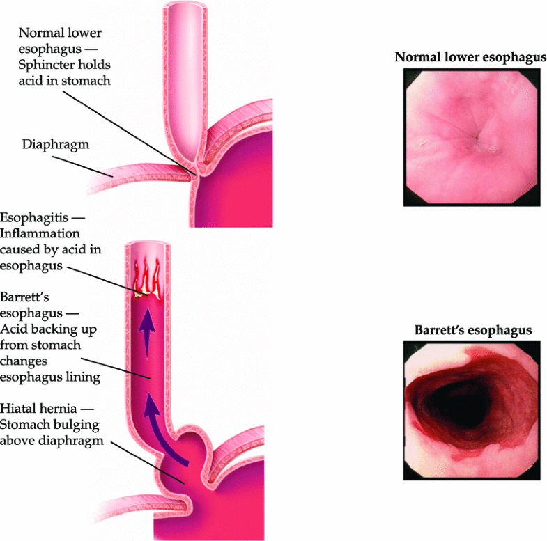 Screening for Barrett’s Esophagus Results from a PopulationBased