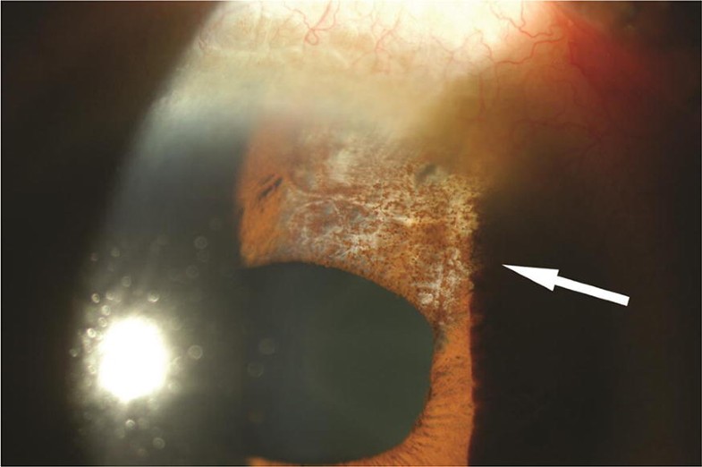 Clinical features of anterior uveitis caused by three different herpes