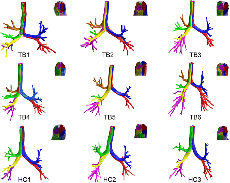 Airflow in Tracheobronchial Tree of Subjects with Tracheal Bronchus