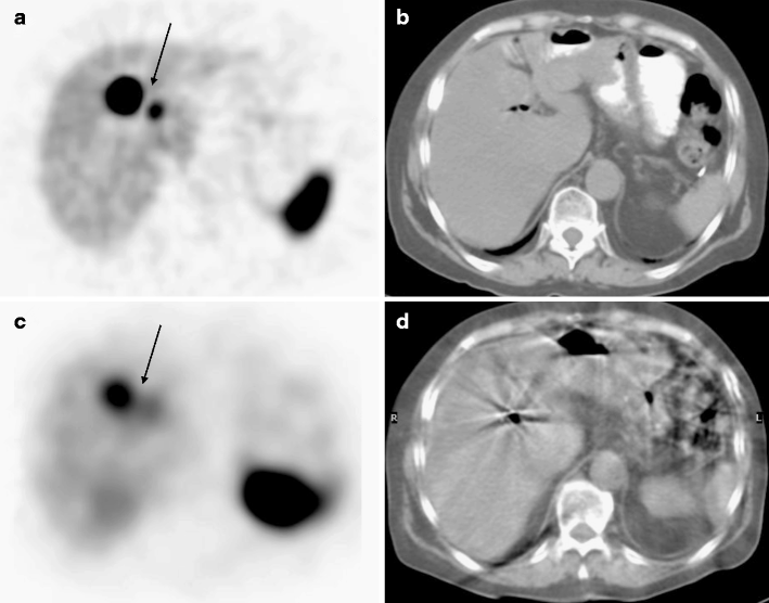 68Ga-DOTA-NOC PET/CT Imaging of Neuroendocrine Tumors: Comparison with ...