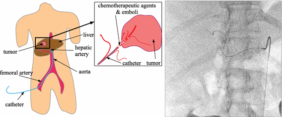 Continuous roadmapping in liver TACE procedures using 2D
