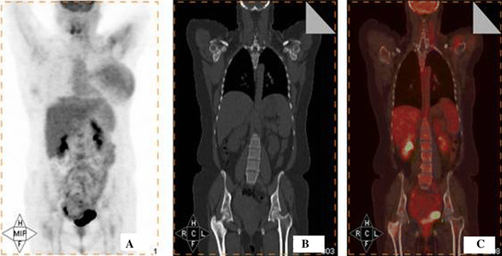 The role of 18F-fluoride PET-CT in the detection of bone metastases in ...