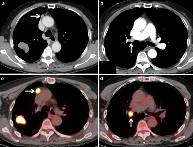 Present and future roles of FDG-PET/CT imaging in the management of ...