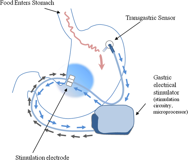 gastric stimulator gastric stimulator