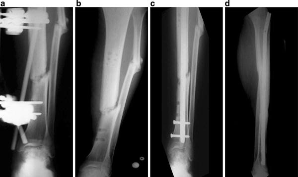 Reamed interlocking intramedullary nailing for the treatment of tibial ...