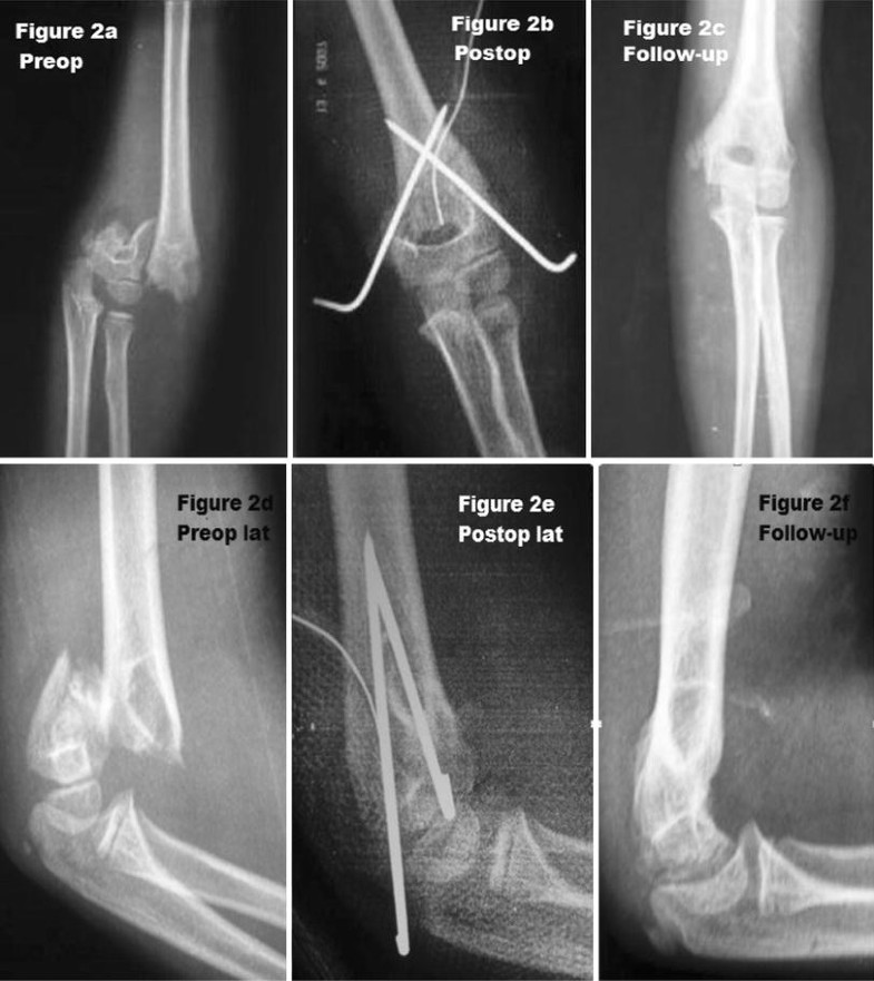 Open reduction and pinning for the treatment of Gartland extension type