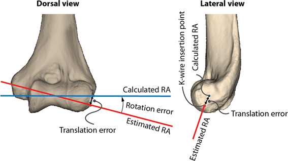 Accuracy in identifying the elbow rotation axis on simulated ...