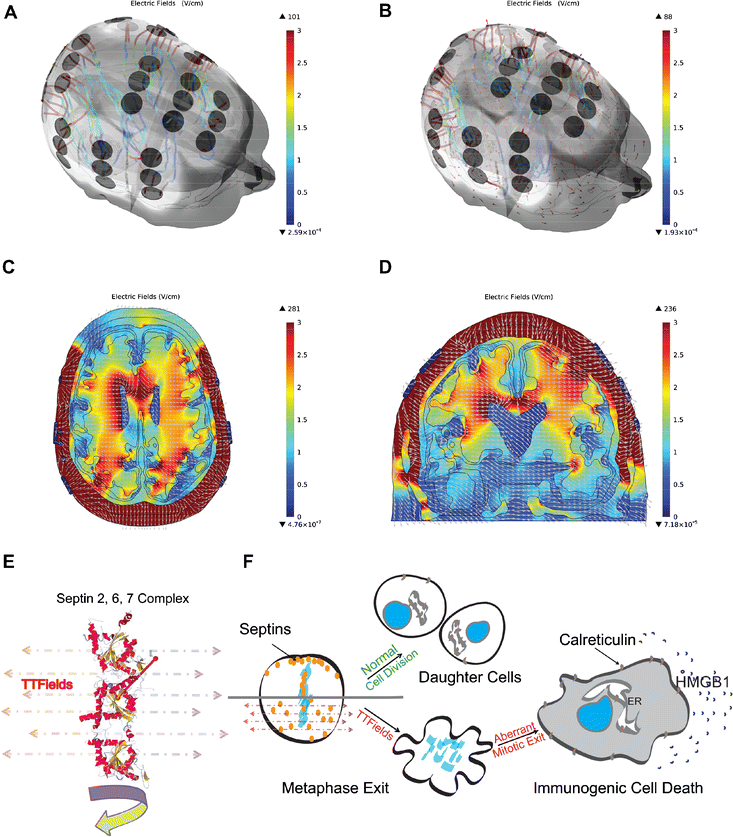 An EvidenceBased Review of Alternating Electric Fields Therapy for