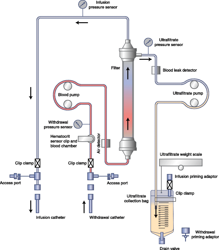 Isolated Ultrafiltration in Heart Failure Patients SpringerLink