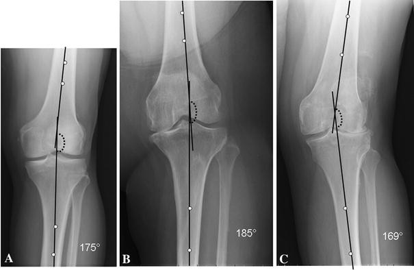 Editorial: What is Varus or Valgus Knee Alignment?: A Call for a ...