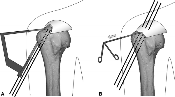 Advantages Of Arthroscopic Transosseous Suture Repair Of The Rotator Cuff Without The Use Of