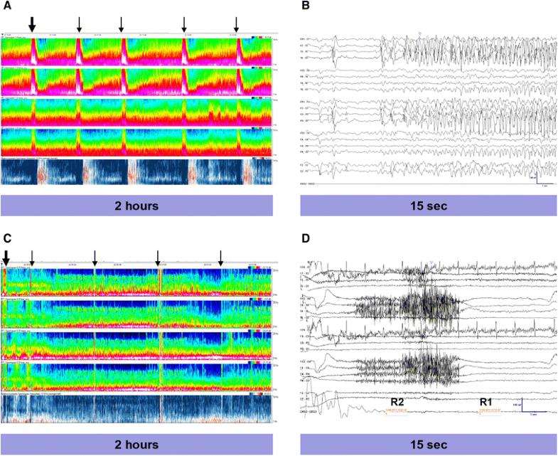 Sensitivity of Compressed Spectral Arrays for Detecting Seizures in ...