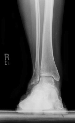 flat foot deformity icd 10 flat foot deformity icd 10