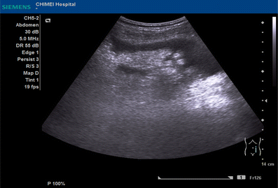 Omental cake | International Journal of Emergency Medicine | Full Text