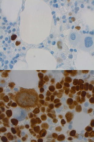 The AML–MDS interface—leukemic transformation in myelodysplastic ...
