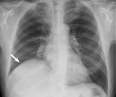 ‘Elevated’ hemidiaphragm due to a pericardial cyst | SpringerLink