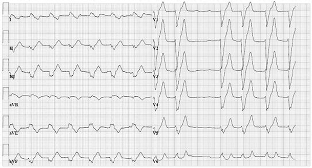 Rate-dependent left bundle branch block caused by hyperkalaemia ...