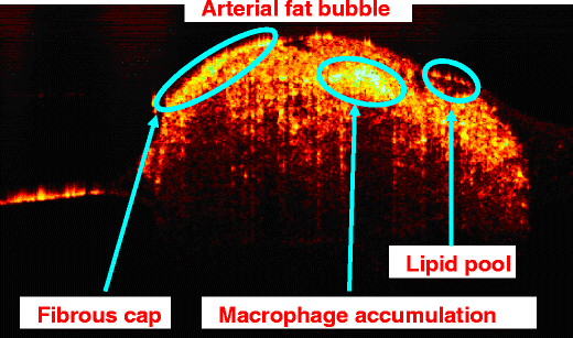 optical coherence tomography scan optical coherence tomography scan