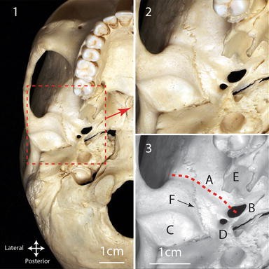 Identification of the posterior deep temporal nerve groove and canal ...