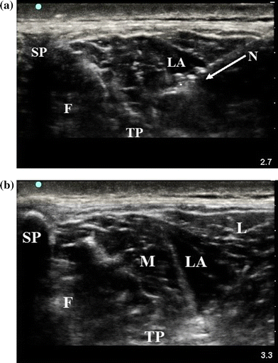 Thoracolumbar interfascial plane (TLIP) block: a pilot study in ...