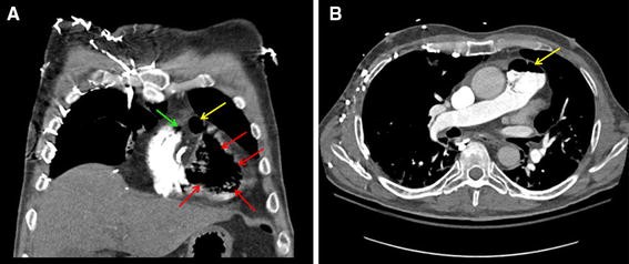 Massive venous air embolism | SpringerLink