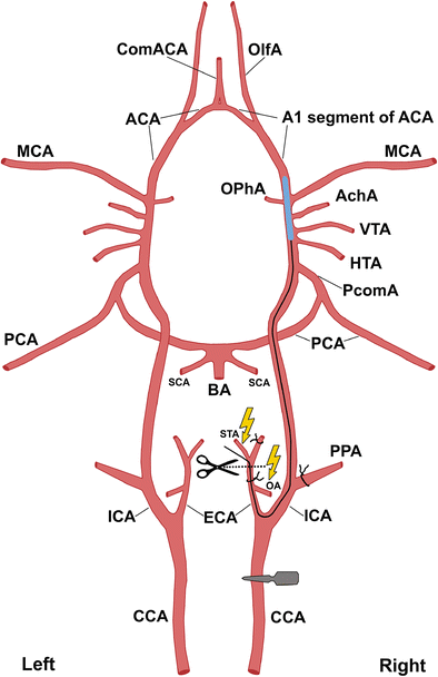 Middle Cerebral Artery Mri