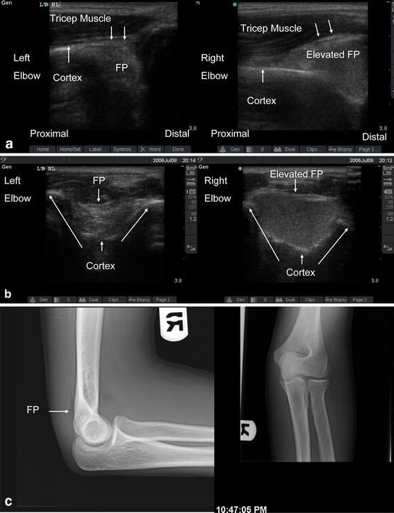 Rapid screening for the posterior fat pad sign in suspected pediatric
