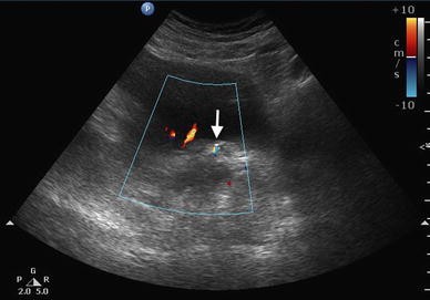 Twinkle twinkle little stone: utilizing color Doppler in ...